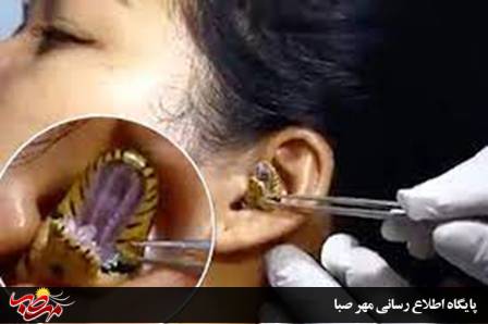 تصاویر لحظه باورنکردنی خارج کردن یک مار از گوش دختر جوان